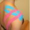 Kinesiotaping - np. przy bolesnym barku