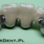 CerDent, korony frezowane, interlock, ceramika