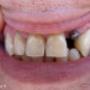 Dodane przez klienta firmy 25.08.2016 - Implant ząb 22 Cerdent