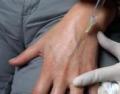 medycyna estetyczna - mezoterapia igłowa