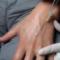 mezoterapia-iglowa