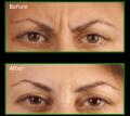przed-i-po-botox