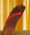 Laseroterapia