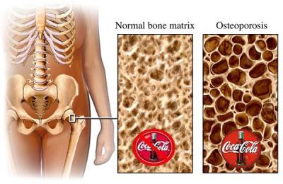 Osteoporoza-kruche-kosci