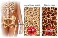 Co to jest Osteoporoza