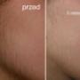 Epilfree