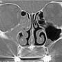 laryngolog