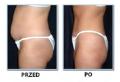 I lipo zimny laser