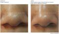Oczyszczanie cery PCA Skin Detox Gel