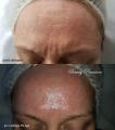 Peeling-PQAge