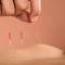 Kurs-Dry-Needling