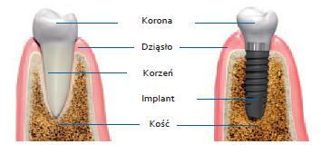 Implanty-Bydgoszcz