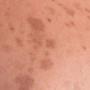 choroby skóry, dermatolog, wenerolog, choroby weneryczne, zmiany skóry, choroby weneryczne, leczenie