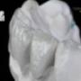 No prep Veneers. Refractory.