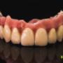metaloporcelana na implantach