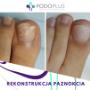 Rekonstrukcja paznokcia