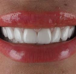 Otodent Smile