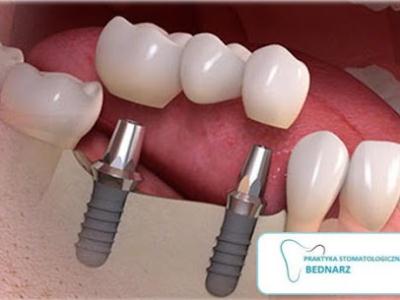 implant