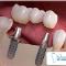 implant