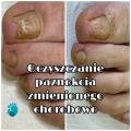 Oczyszczenie paznokci zmienionych chorobowo