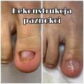 Rekonstrukcja płytki paznokciowej