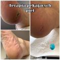 Terapia pękających pięt