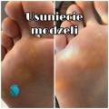 Usuwanie modzeli – 1szt
