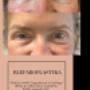 Blefaroplastyka - podnoszenie powiek górnych podnoszenie powiek dolnych