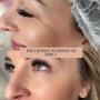Botox - Botoks