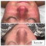 Efekty Laseroterapii Alma w Kashmir Spa