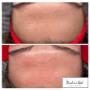 Efekty Retix C w Kashmir Spa