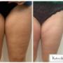 Efekty zabiegu Endermologia + Fala Uderzeniowa w Kashmir Spa