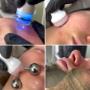 Hydradermabrazja AQUAPURE