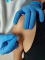 Terapia blizn