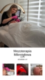 Mezoterapia Mikroigłowa