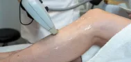 Depilacja laserowa