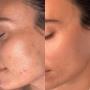 Efekty mezoterapii w MS Aesthetic Clinic. Zdjecie przed i po zabiegu, widoczna poprawa tekstury skory i splycenie blizn potradzikowych.