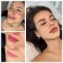 Efekty naturalnego modelowania ust w MS Aesthetic Clinic. Kolaz przed i po zabiegu.